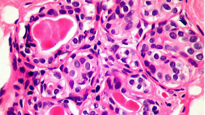 Inmunoterapia contra el cáncer: el esperanzador tratamiento para tratar “todo tipo cáncer”