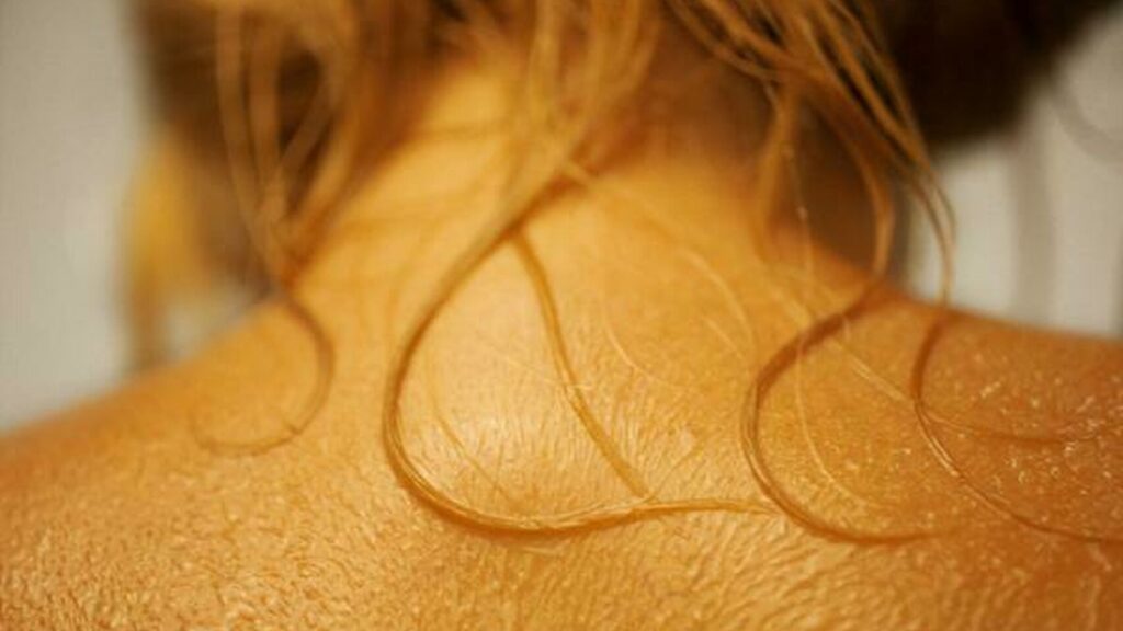 Gel que combate el cáncer de piel