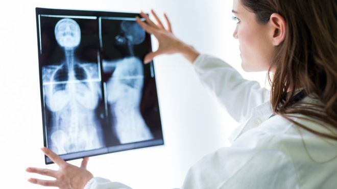 Cáncer de mama metastásico y sus síntomas