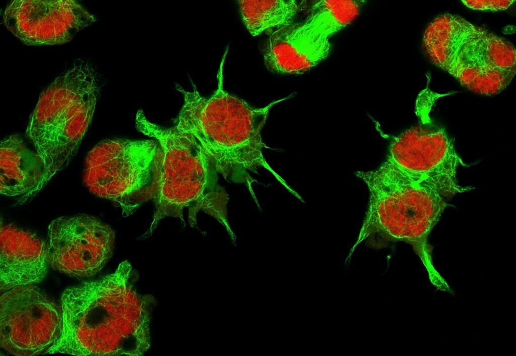 Una proteína contribuye a la agresividad de un raro cáncer infantil